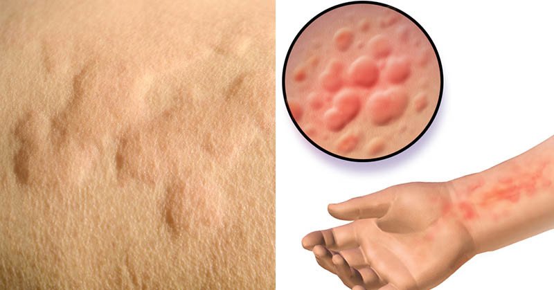 Cold Urticaria