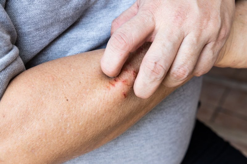 Eczema
