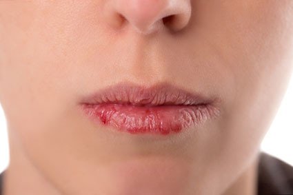 Chapped Lips